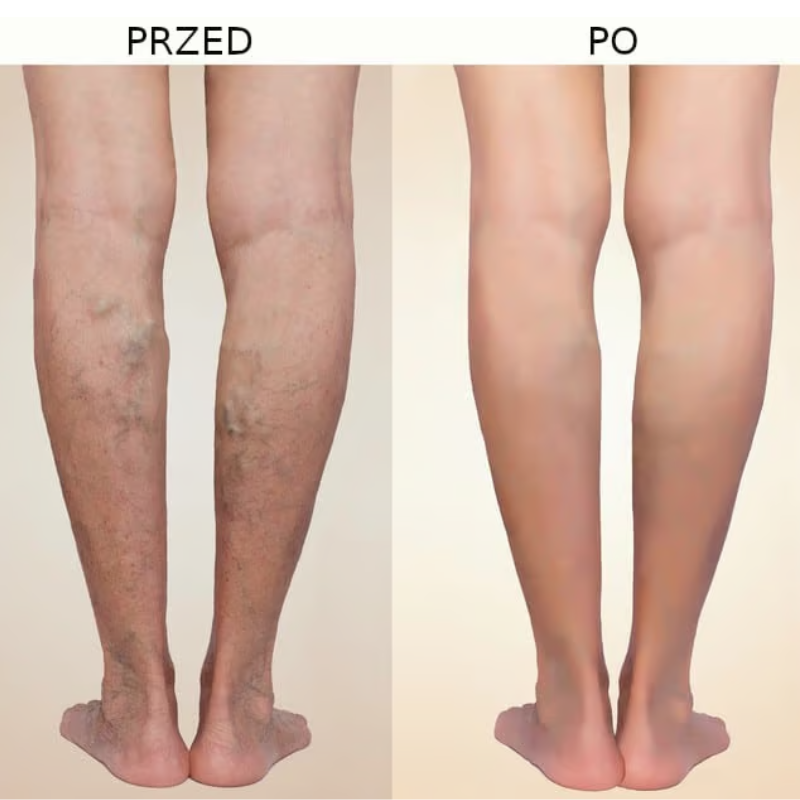 Nogi przed i po zastosowaniu VenoZip